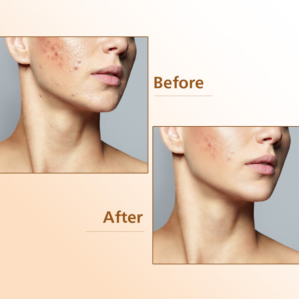 Acnedac Acne Spot Corrector Cream