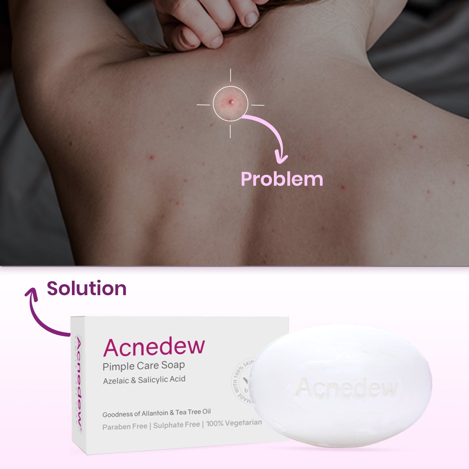 Acnedew Pimple Care Soap (100 gm)
