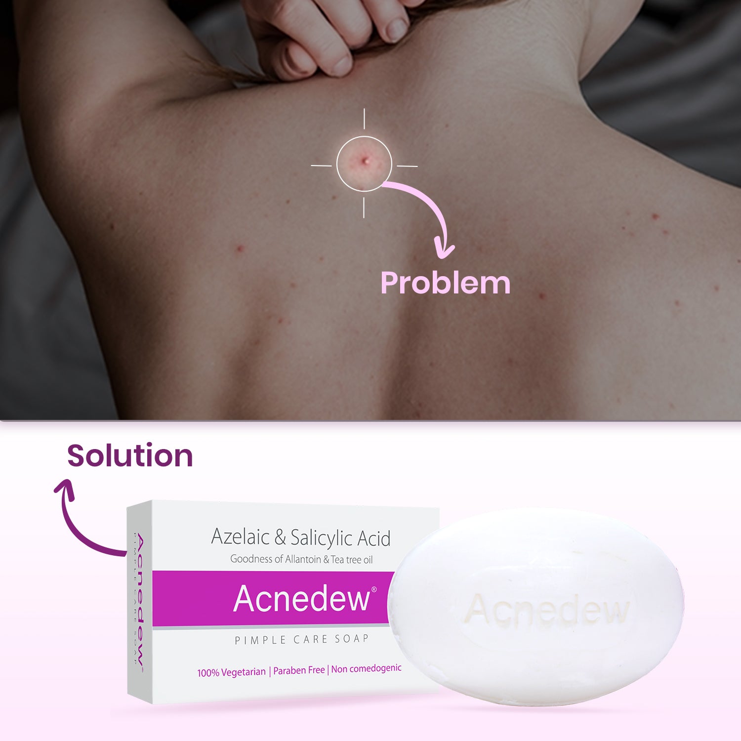 Acnedew Anti Acne & Anti Pimple Soap (75 gm)